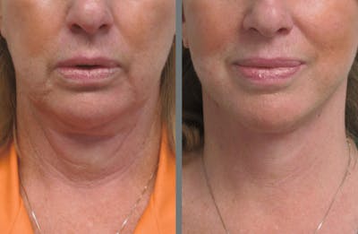 Facelift Before & After Gallery - Patient 54030915 - Image 1