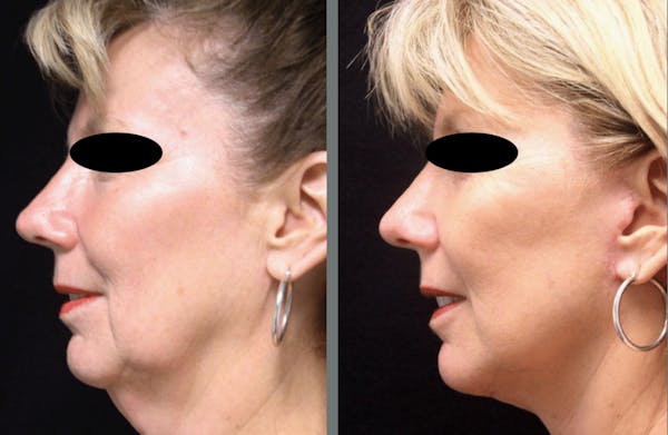 Facelift Before & After Gallery - Patient 54030916 - Image 1