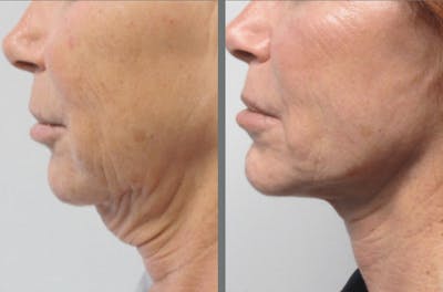 Facelift Before & After Gallery - Patient 54030917 - Image 1