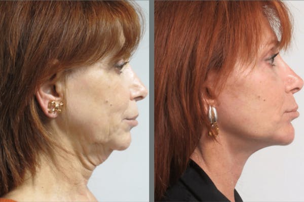 Facelift Before & After Gallery - Patient 54030918 - Image 1
