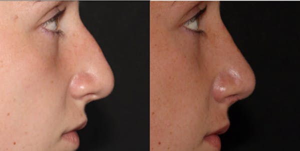 Rhinoplasty Before & After Gallery - Patient 54185044 - Image 1