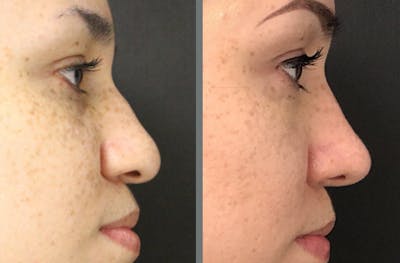Rhinoplasty Before & After Gallery - Patient 54185049 - Image 1
