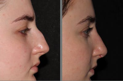 Rhinoplasty Before & After Gallery - Patient 54185050 - Image 1