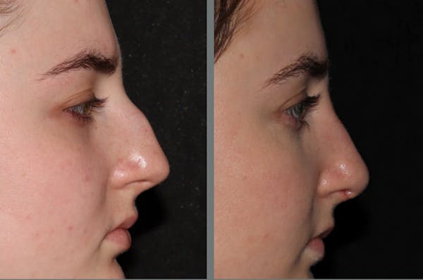 Rhinoplasty Before & After Gallery - Patient 54185050 - Image 1