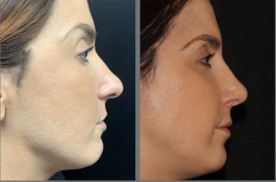 Rhinoplasty Before & After Gallery - Patient 54185051 - Image 1