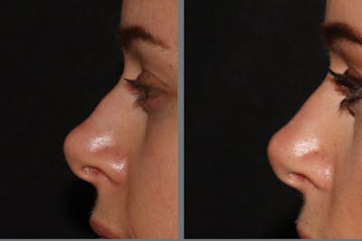 Rhinoplasty Before & After Gallery - Patient 54185052 - Image 1