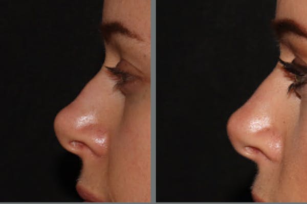 Rhinoplasty Before & After Gallery - Patient 54185052 - Image 1