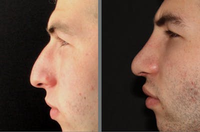 Rhinoplasty Before & After Gallery - Patient 54185053 - Image 1