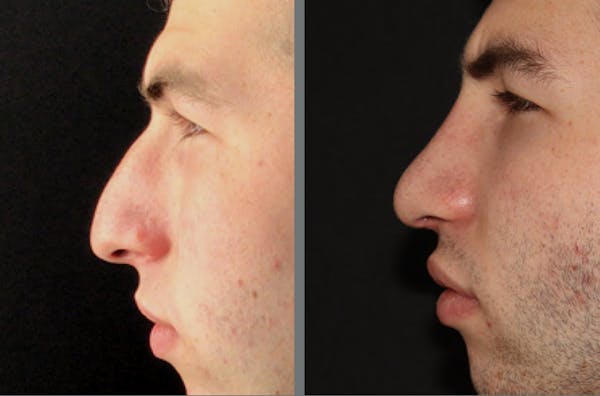 Rhinoplasty Before & After Gallery - Patient 54185053 - Image 1