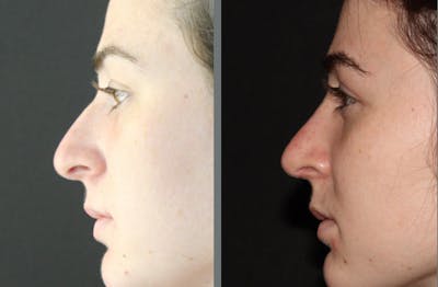 Rhinoplasty Before & After Gallery - Patient 54185054 - Image 1