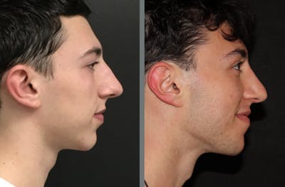 Rhinoplasty Before & After Gallery - Patient 54185055 - Image 1