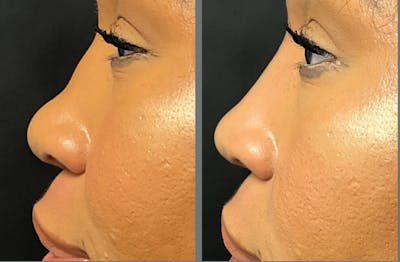 Rhinoplasty Before & After Gallery - Patient 54185056 - Image 1