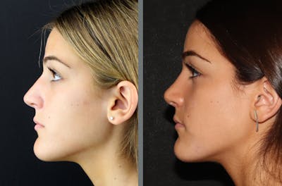 Rhinoplasty Before & After Gallery - Patient 54185057 - Image 1