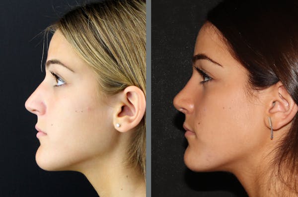 Rhinoplasty Before & After Gallery - Patient 54185057 - Image 1