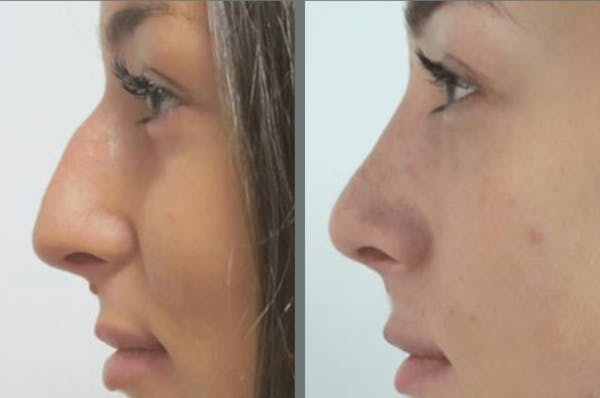 Rhinoplasty Before & After Gallery - Patient 54185058 - Image 1