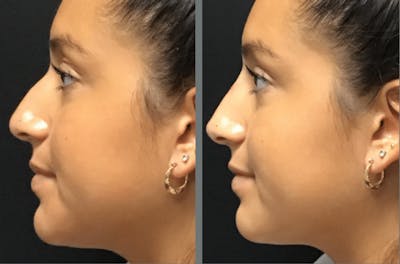 Rhinoplasty Before & After Gallery - Patient 54185059 - Image 1