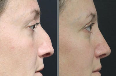Rhinoplasty Before & After Gallery - Patient 54185060 - Image 1