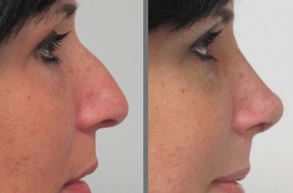Rhinoplasty Before & After Gallery - Patient 54185061 - Image 1