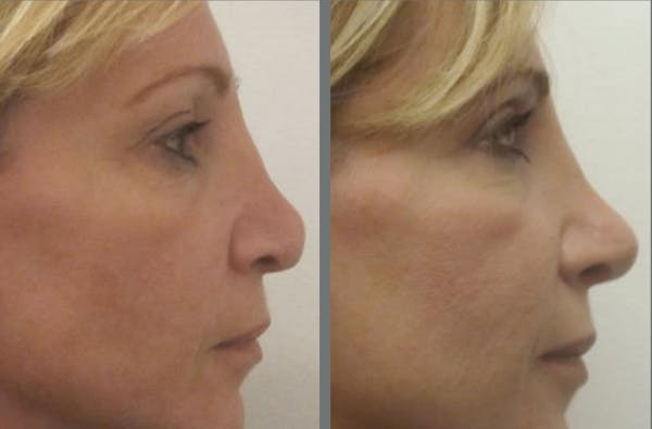 Rhinoplasty Before & After Gallery - Patient 54185062 - Image 1