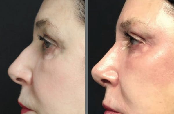 Rhinoplasty Before & After Gallery - Patient 54185063 - Image 1