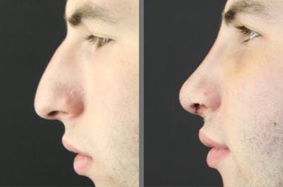 Rhinoplasty Before & After Gallery - Patient 54185064 - Image 1