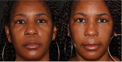  Blepharoplasty Before & After Gallery - Patient 54187546 - Image 1