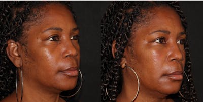  Blepharoplasty Before & After Gallery - Patient 54187546 - Image 2