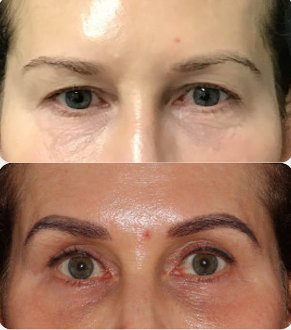  Blepharoplasty Before & After Gallery - Patient 54187547 - Image 1