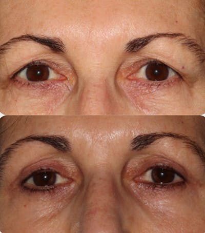  Blepharoplasty Before & After Gallery - Patient 54187548 - Image 1