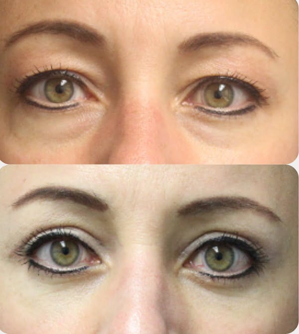  Blepharoplasty Before & After Gallery - Patient 54187549 - Image 1