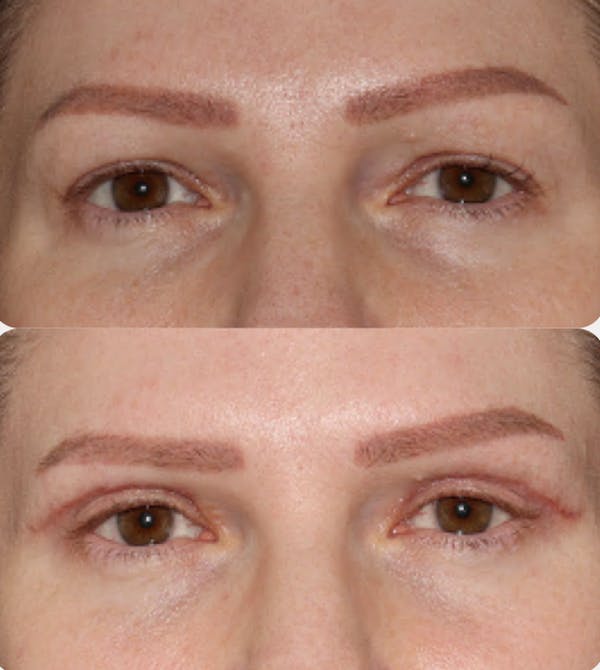  Blepharoplasty Before & After Gallery - Patient 54187550 - Image 1
