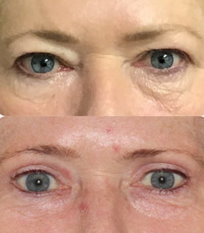 Blepharoplasty Before & After Gallery - Patient 54187551 - Image 1