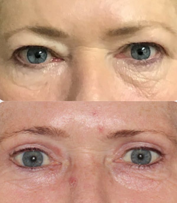  Blepharoplasty Before & After Gallery - Patient 54187551 - Image 1