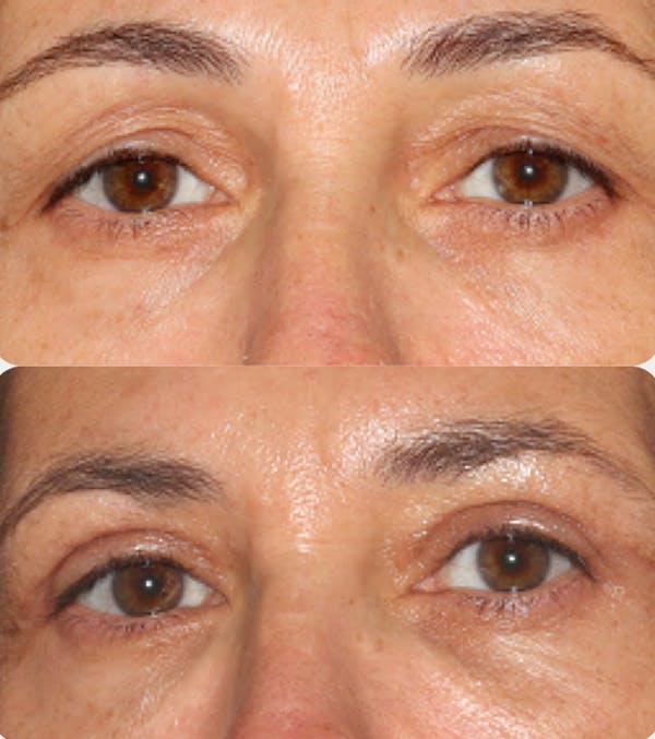  Blepharoplasty Before & After Gallery - Patient 54187552 - Image 1