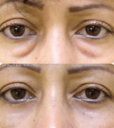  Blepharoplasty Before & After Gallery - Patient 54187553 - Image 1