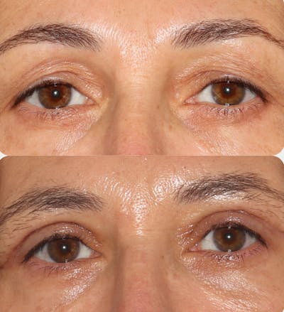  Blepharoplasty Before & After Gallery - Patient 54187554 - Image 1