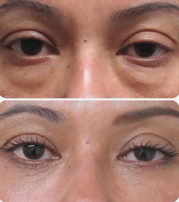  Blepharoplasty Before & After Gallery - Patient 54187555 - Image 1