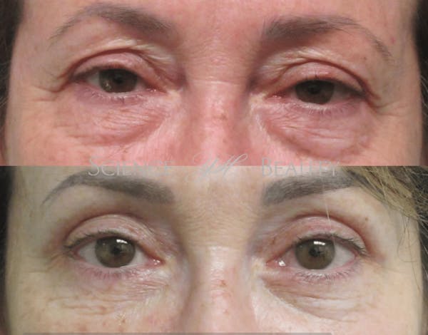  Blepharoplasty Before & After Gallery - Patient 54187556 - Image 1