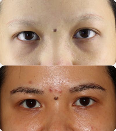 Hair Transplant Gallery - Patient 54187627 - Image 1
