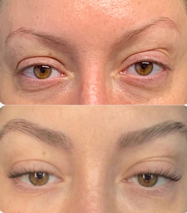 Eyebrow Transplant Before & After Gallery - Patient 359213 - Image 1