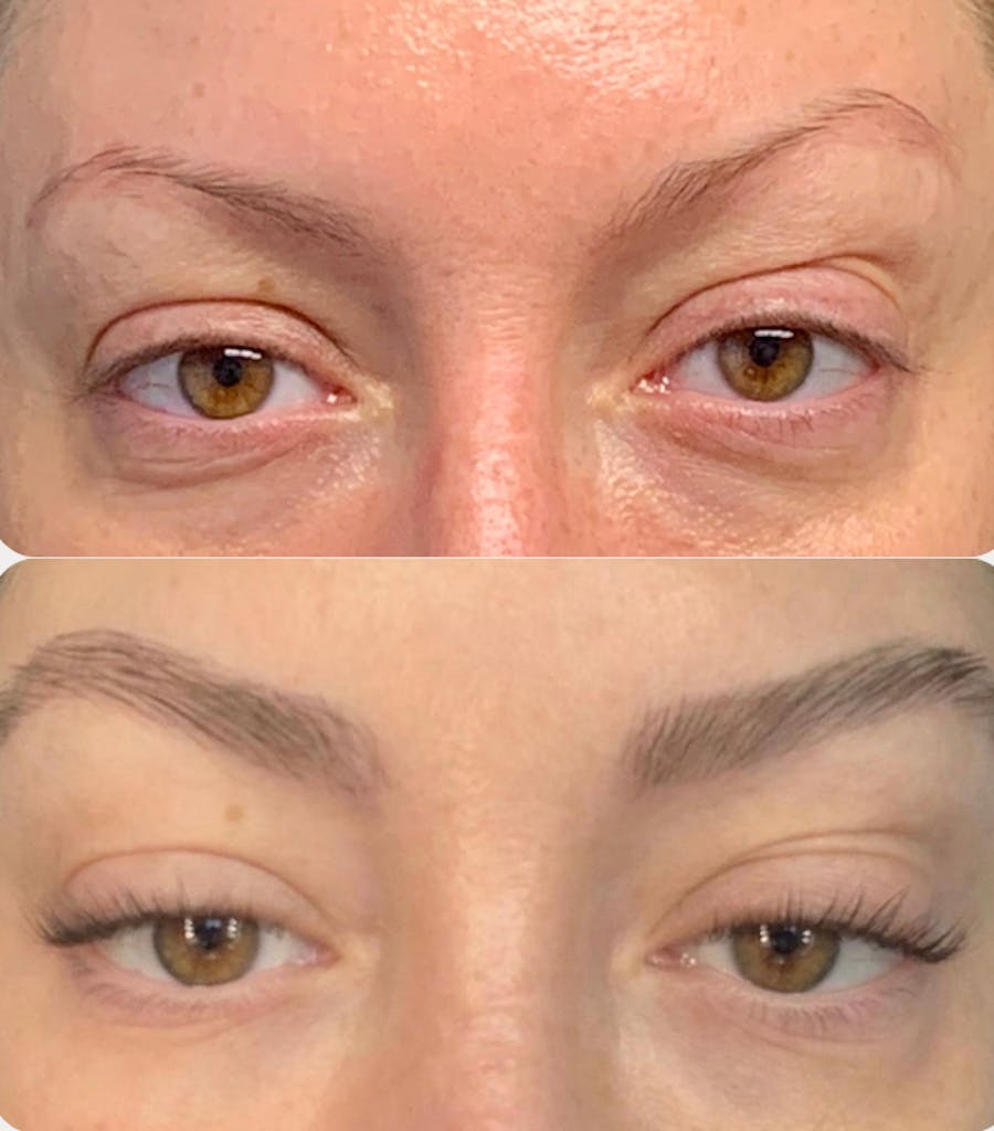 Eyebrow Transplant Before & After Gallery - Patient 359213 - Image 1