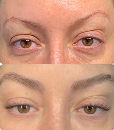 Eyebrow Transplant Before & After Gallery - Patient 359213 - Image 1