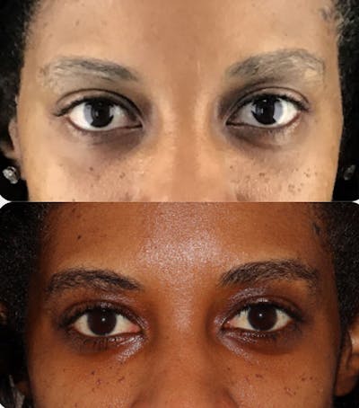 Eyebrow Transplant Before & After Gallery - Patient 117791 - Image 1