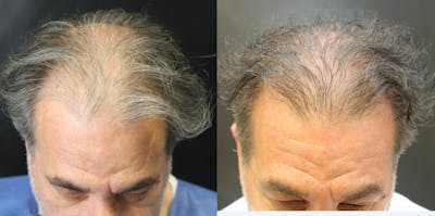 Hair Transplant Before & After Gallery - Patient 54187631 - Image 1