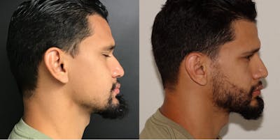 Hair Transplant Gallery - Patient 54187632 - Image 2