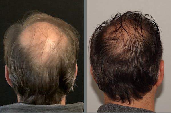 Hair Transplant Before & After Gallery - Patient 54187633 - Image 1