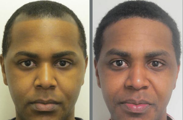 Hair Transplant Before & After Gallery - Patient 54187635 - Image 1