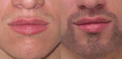 Hair Transplant Before & After Gallery - Patient 54187636 - Image 1