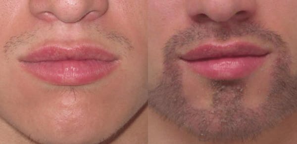 Hair Transplant Before & After Gallery - Patient 54187636 - Image 1