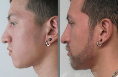Hair Transplant Before & After Gallery - Patient 54187637 - Image 1